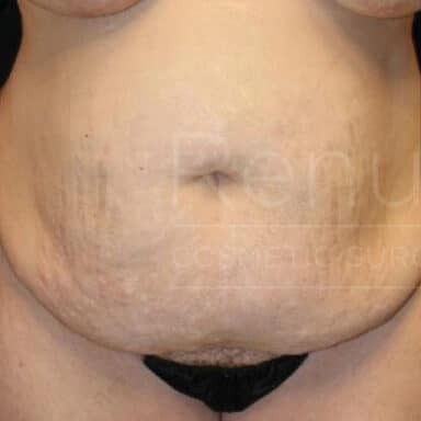 Procedure before and after - before