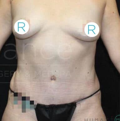 Procedure before and after - after