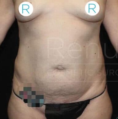 Procedure before and after - before