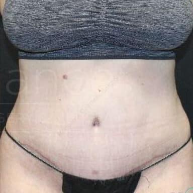 Procedure before and after - after