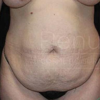 Procedure before and after - before