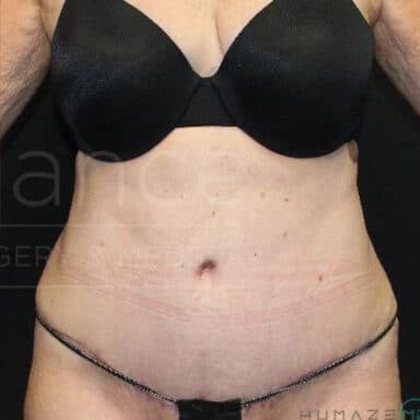Procedure before and after - after