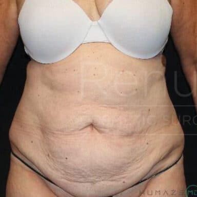 Procedure before and after - before