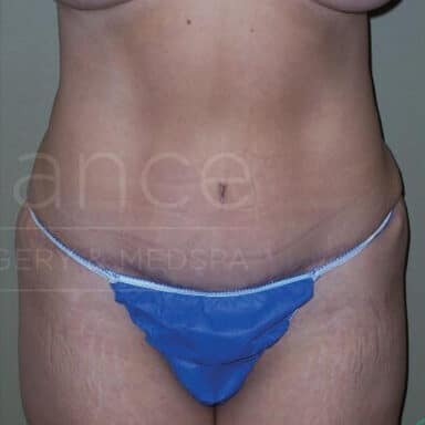 Procedure before and after - after