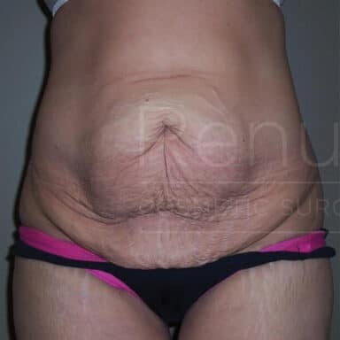 Procedure before and after - before