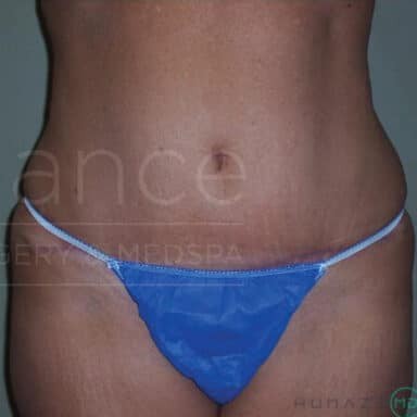 Procedure before and after - after