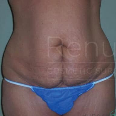 Procedure before and after - before