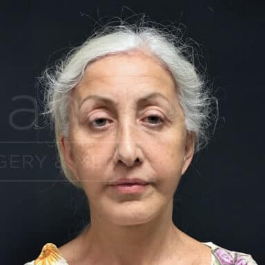 Procedure before and after - after
