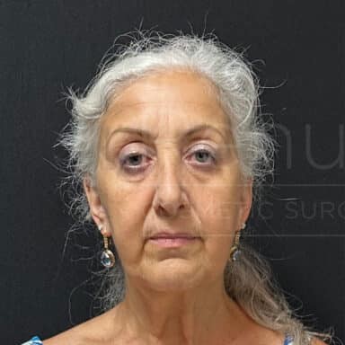 Procedure before and after - before