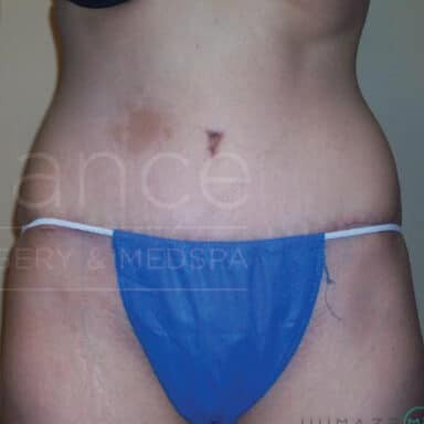 Procedure before and after - after