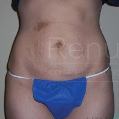 Procedure before and after - before
