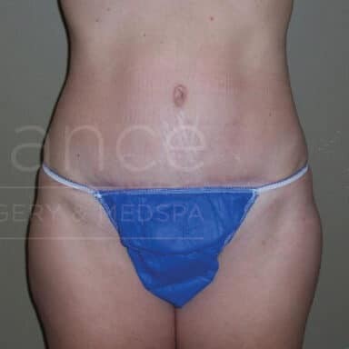Procedure before and after - after