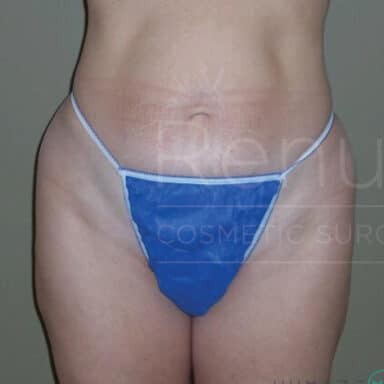 Procedure before and after - before