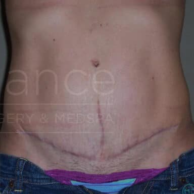 Procedure before and after - after