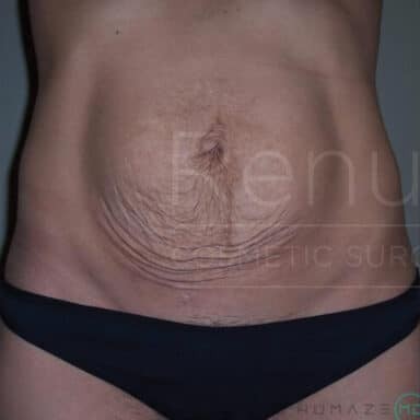 Procedure before and after - before