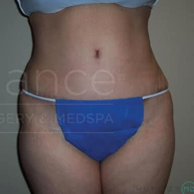 Procedure before and after - after