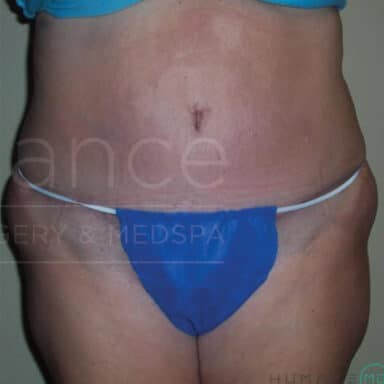 Procedure before and after - after