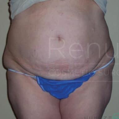 Procedure before and after - before