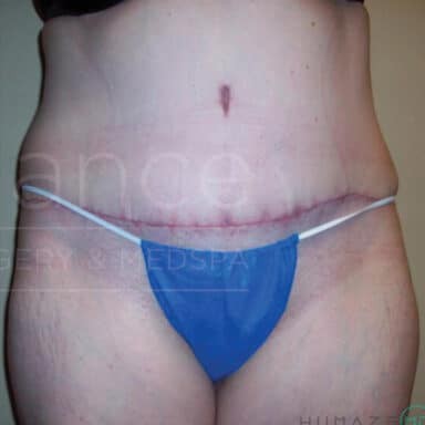 Procedure before and after - after