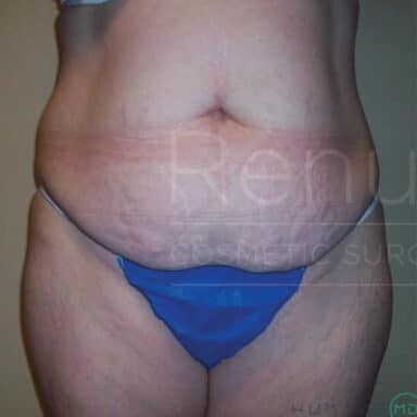 Procedure before and after - before