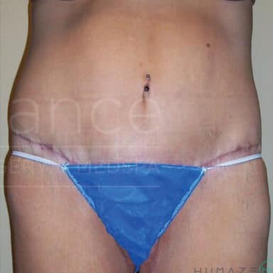 Procedure before and after - after