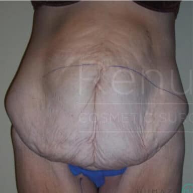 Procedure before and after - before