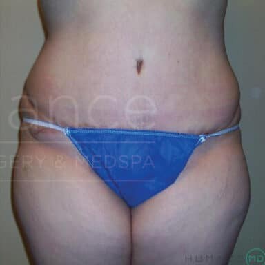 Procedure before and after - after