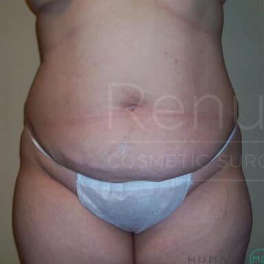 Procedure before and after - before