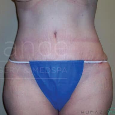 Procedure before and after - after