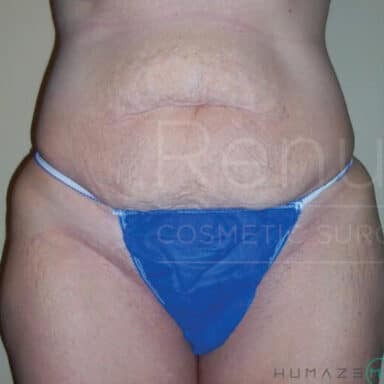 Procedure before and after - before