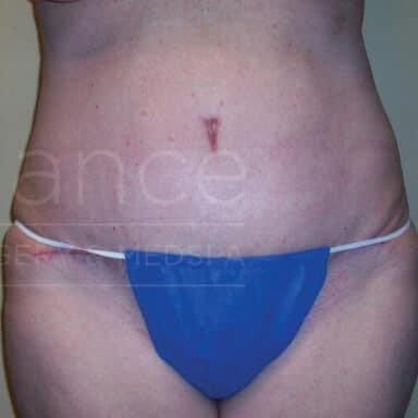 Procedure before and after - after