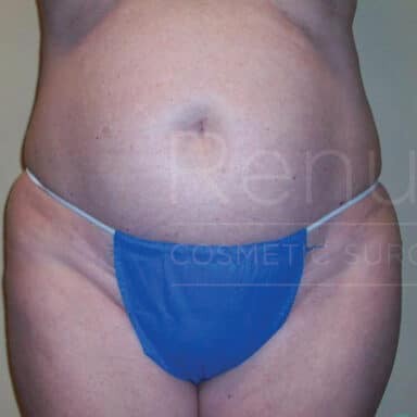 Procedure before and after - before