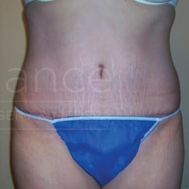 Procedure before and after - after