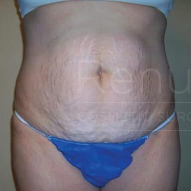 Procedure before and after - before