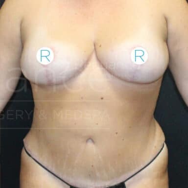 Procedure before and after - after