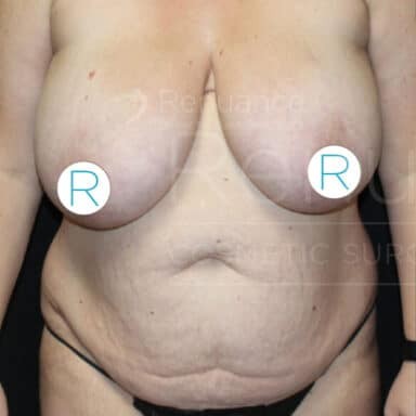 Procedure before and after - before