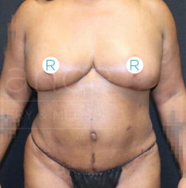 Procedure before and after - after