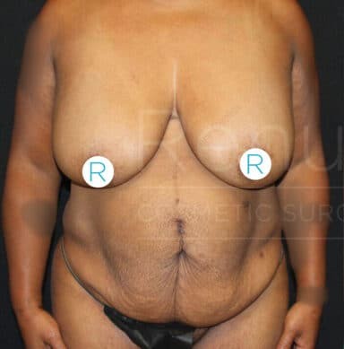 Procedure before and after - before