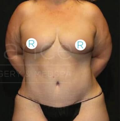 Procedure before and after - after
