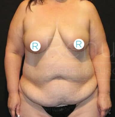 Procedure before and after - before
