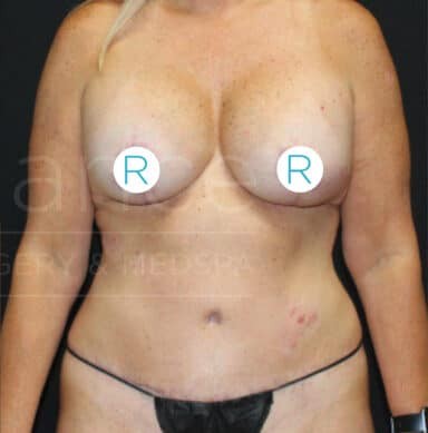 Procedure before and after - after