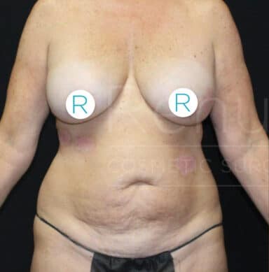 Procedure before and after - before