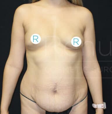 Procedure before and after - before