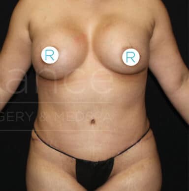 Procedure before and after - after