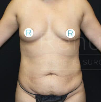 Procedure before and after - before