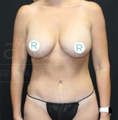 Procedure before and after - after