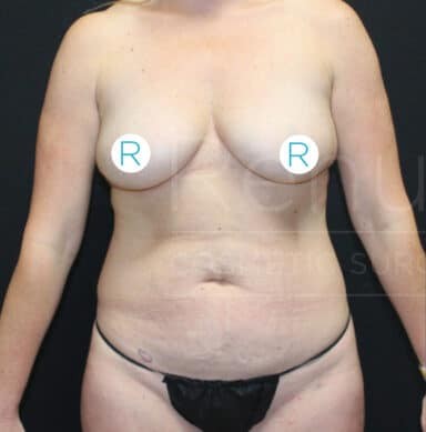 Procedure before and after - before