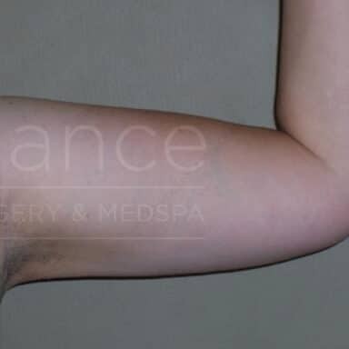 Procedure before and after - after