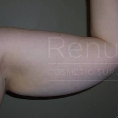 Procedure before and after - before