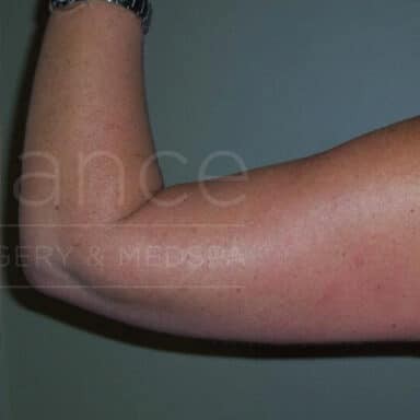 Procedure before and after - after